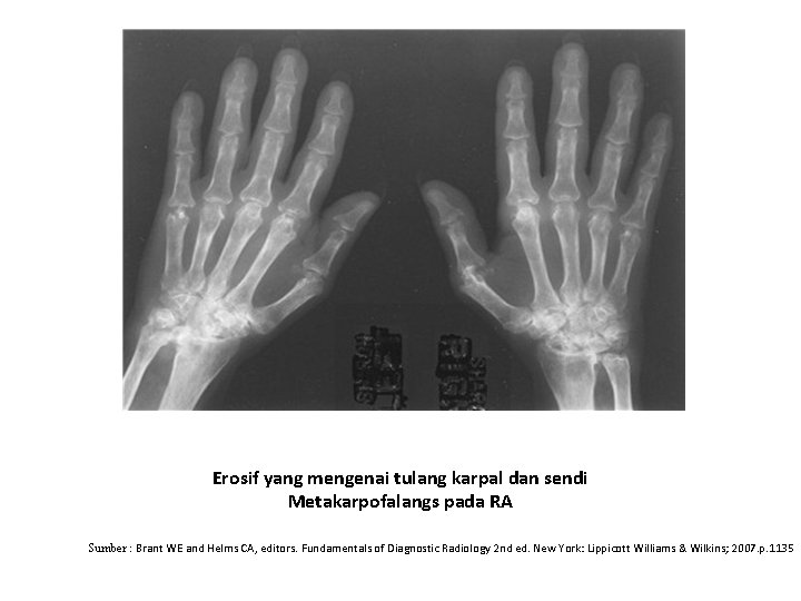 Erosif yang mengenai tulang karpal dan sendi Metakarpofalangs pada RA Sumber : Brant WE