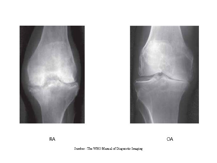 RA OA Sumber : The WHO Manual of Diagnostic Imaging 