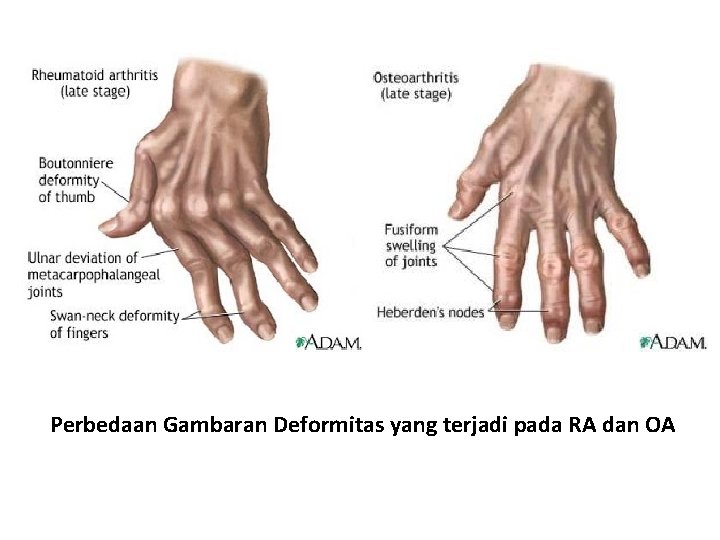 Perbedaan Gambaran Deformitas yang terjadi pada RA dan OA 