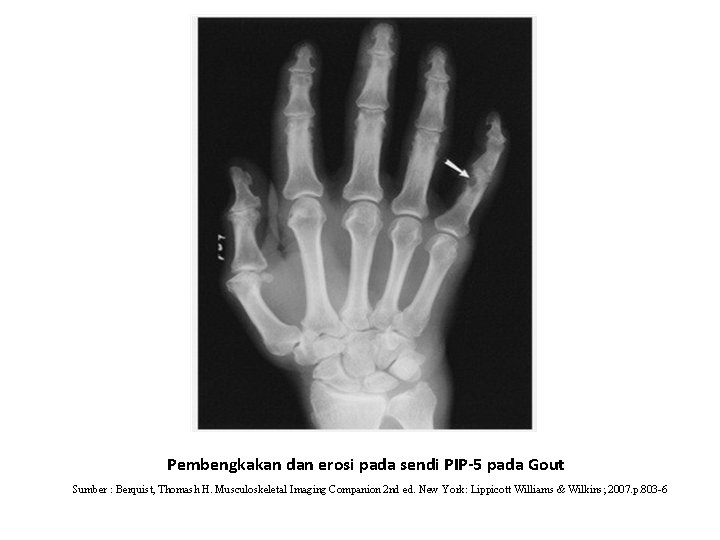 Pembengkakan dan erosi pada sendi PIP-5 pada Gout Sumber : Berquist, Thomash H. Musculoskeletal