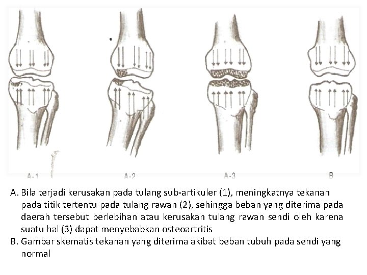 A. Bila terjadi kerusakan pada tulang sub-artikuler (1), meningkatnya tekanan pada titik tertentu pada