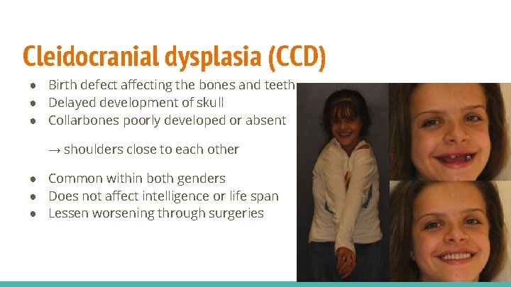 Cleidocranial dysplasia (CCD) ● Birth defect affecting the bones and teeth ● Delayed development