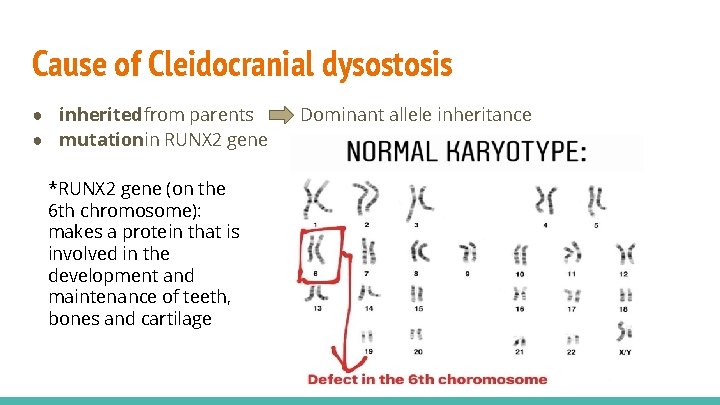 Cause of Cleidocranial dysostosis ● inherited from parents ● mutationin RUNX 2 gene *RUNX