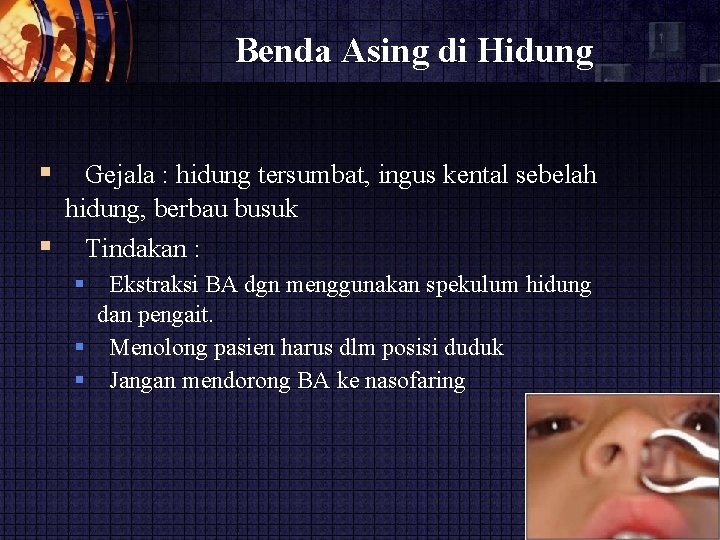 Benda Asing di Hidung Gejala : hidung tersumbat, ingus kental sebelah hidung, berbau busuk