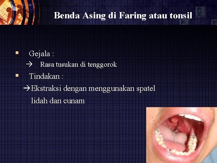 Benda Asing di Faring atau tonsil Gejala : Rasa tusukan di tenggorok Tindakan :