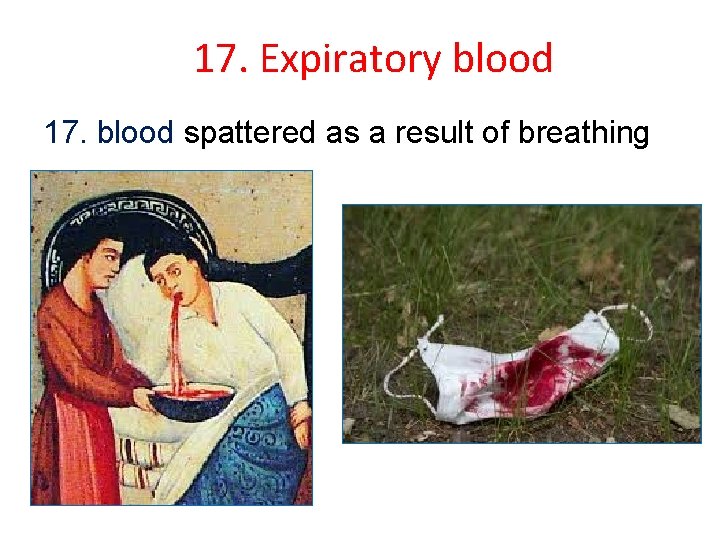 17. Expiratory blood 17. blood spattered as a result of breathing 