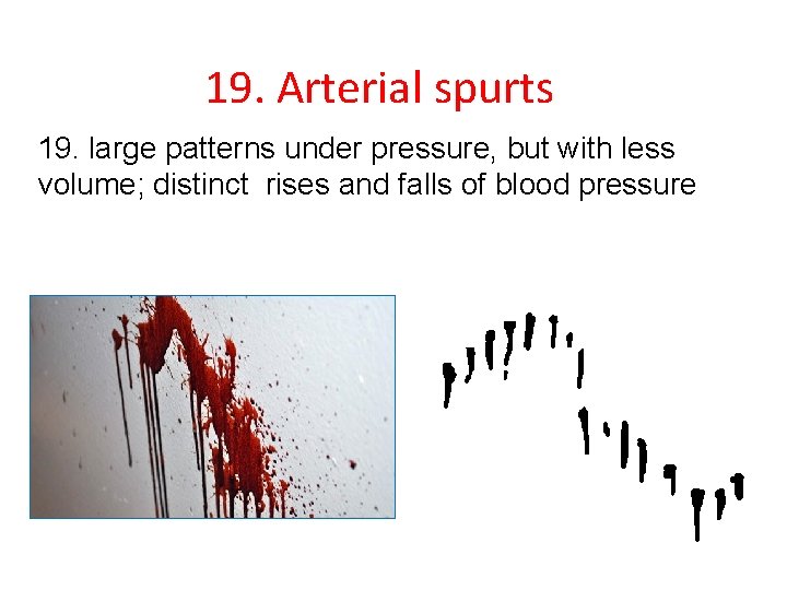 19. Arterial spurts 19. large patterns under pressure, but with less volume; distinct rises