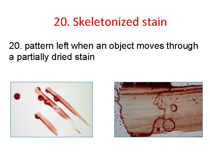 20. Skeletonized stain 20. pattern left when an object moves through a partially dried