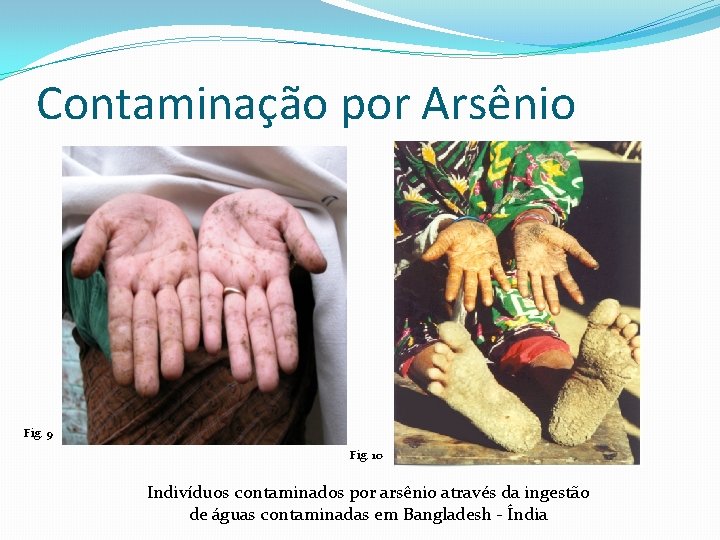 Contaminação por Arsênio Fig. 9 Fig. 10 Indivíduos contaminados por arsênio através da ingestão