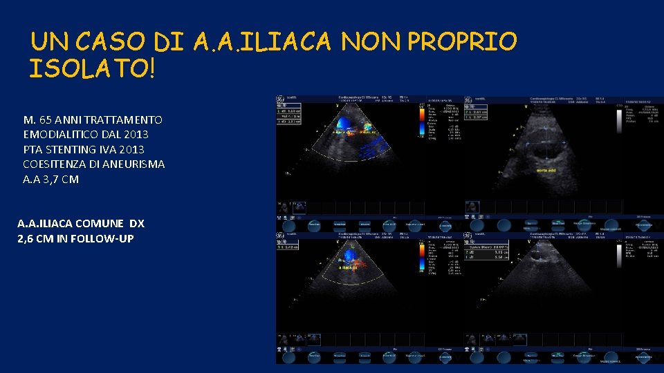 UN CASO DI A. A. ILIACA NON PROPRIO ISOLATO! M. 65 ANNI TRATTAMENTO EMODIALITICO