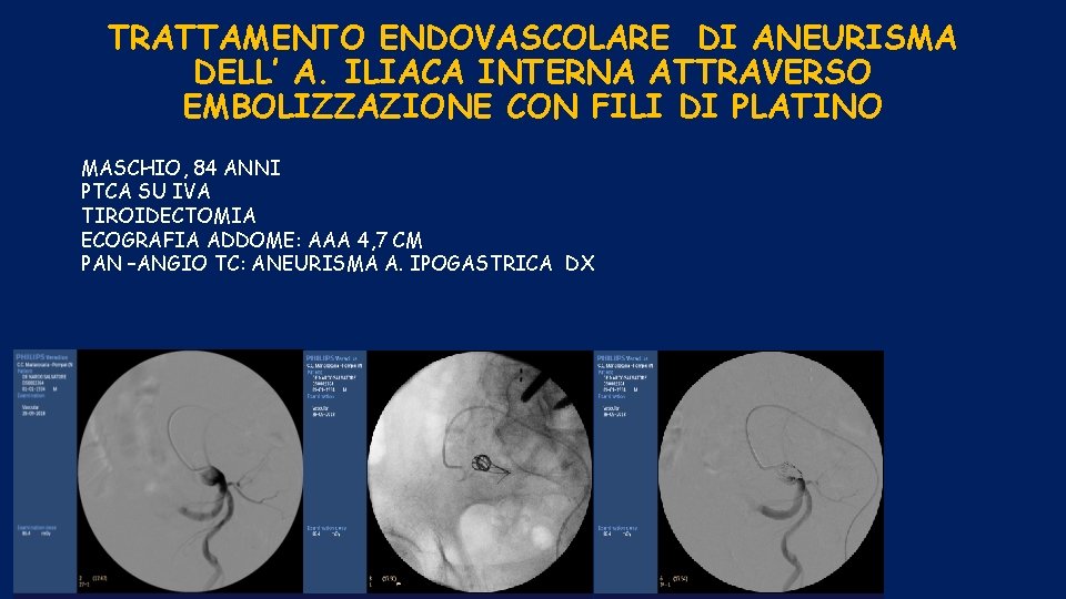 TRATTAMENTO ENDOVASCOLARE DI ANEURISMA DELL’ A. ILIACA INTERNA ATTRAVERSO EMBOLIZZAZIONE CON FILI DI PLATINO