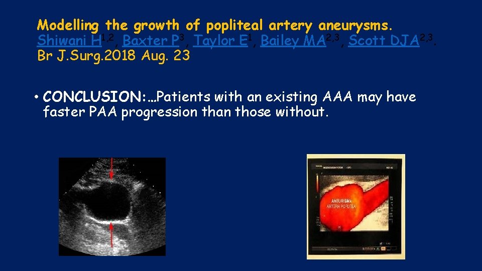 Modelling the growth of popliteal artery aneurysms. Shiwani H 1, 2, Baxter P 3,