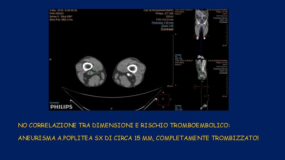 NO CORRELAZIONE TRA DIMENSIONI E RISCHIO TROMBOEMBOLICO: ANEURISMA A. POPLITEA SX DI CIRCA 15