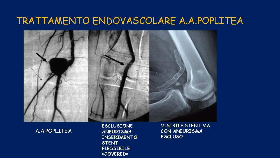 TRATTAMENTO ENDOVASCOLARE A. A. POPLITEA ESCLUSIONE ANEURISMA INSERIMENTO STENT FLESSIBILE «COVERED» VISIBILE STENT MA