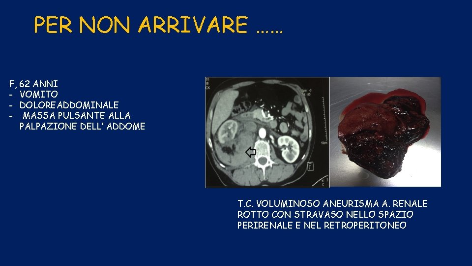 PER NON ARRIVARE …… F, 62 ANNI - VOMITO - DOLOREADDOMINALE - MASSA PULSANTE