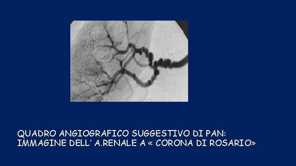 QUADRO ANGIOGRAFICO SUGGESTIVO DI PAN: IMMAGINE DELL’ A. RENALE A « CORONA DI ROSARIO»