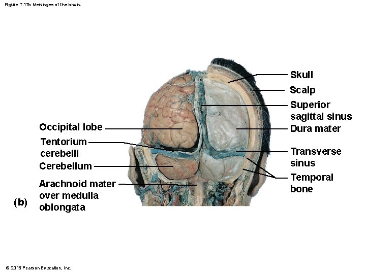 Figure 7. 17 b Meninges of the brain. Skull Scalp Occipital lobe Tentorium cerebelli