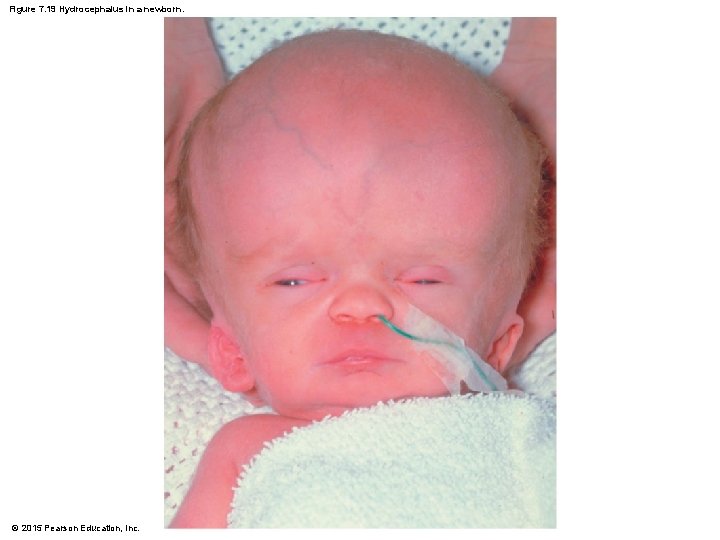 Figure 7. 19 Hydrocephalus in a newborn. © 2015 Pearson Education, Inc. 