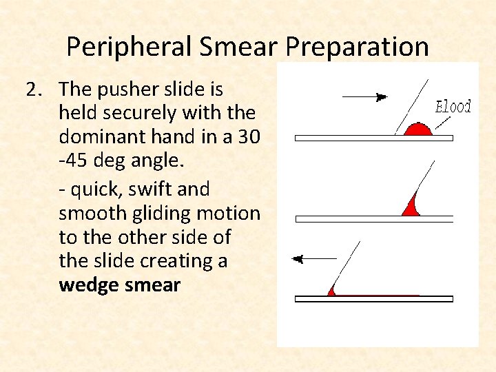 Peripheral Smear Preparation 2. The pusher slide is held securely with the dominant hand