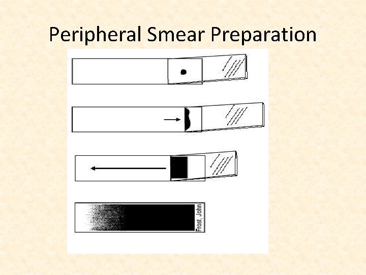 Peripheral Smear Preparation 