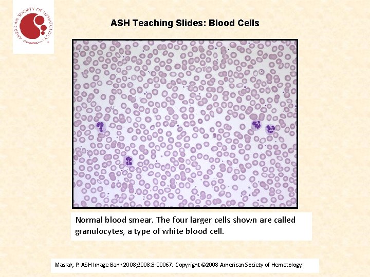 ASH Teaching Slides: Blood Cells Normal blood smear. The four larger cells shown are
