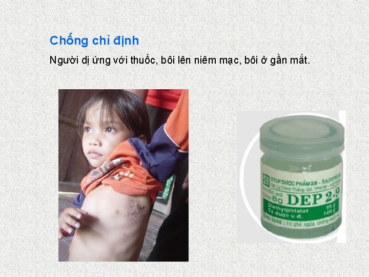 Chống chỉ định Người dị ứng với thuốc, bôi lên niêm mạc, bôi ở