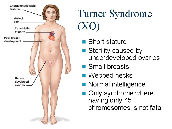 Turner Syndrome (XO) n n n Short stature Sterility caused by underdeveloped ovaries Small