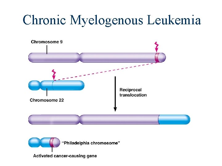 Chronic Myelogenous Leukemia 