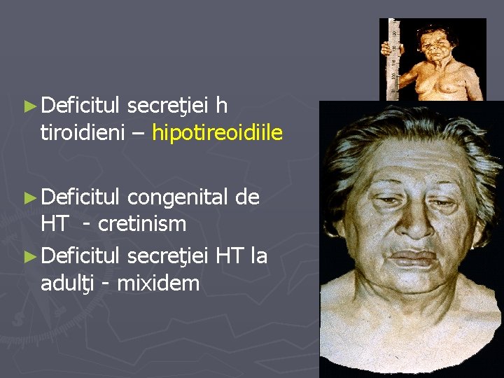 ► Deficitul secreţiei h tiroidieni – hipotireoidiile ► Deficitul congenital de HT - cretinism