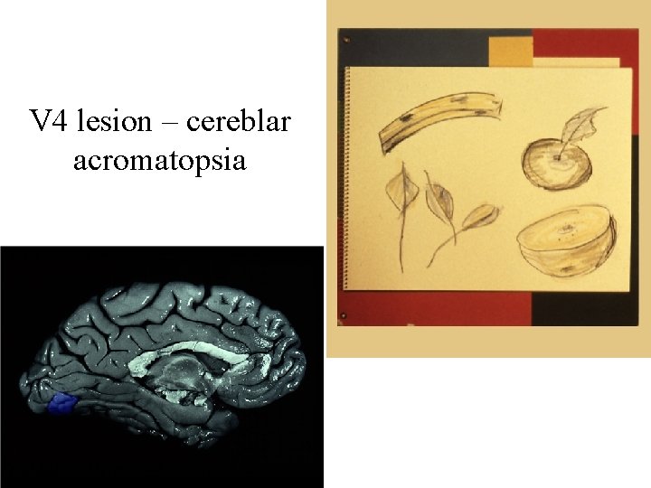 V 4 lesion – cereblar acromatopsia 