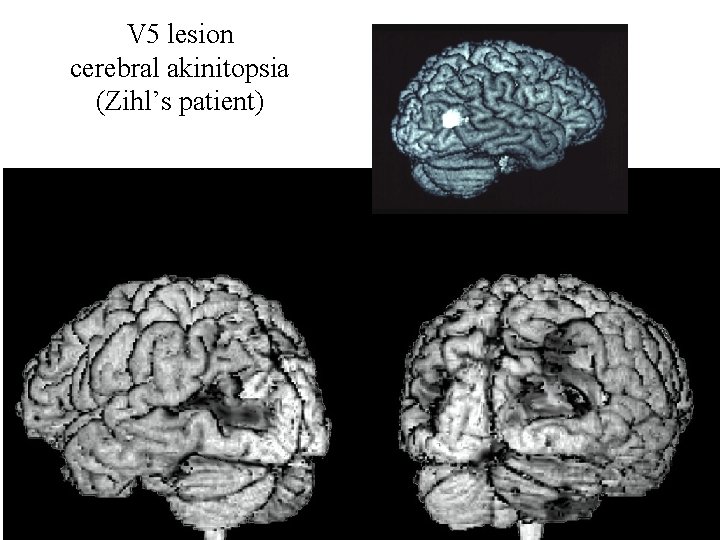 V 5 lesion cerebral akinitopsia (Zihl’s patient) 