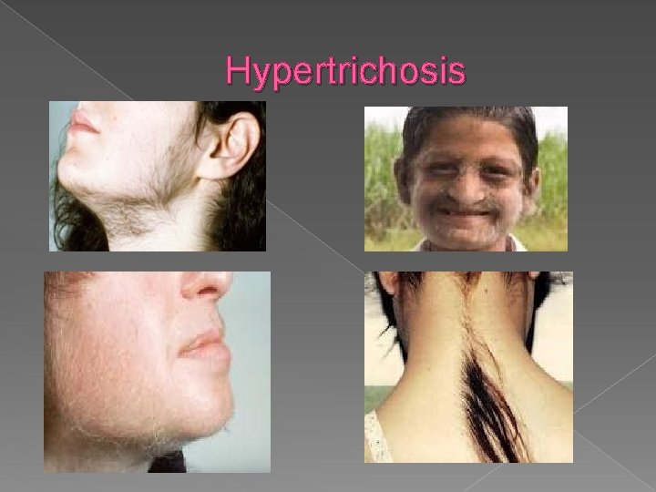 Hypertrichosis 