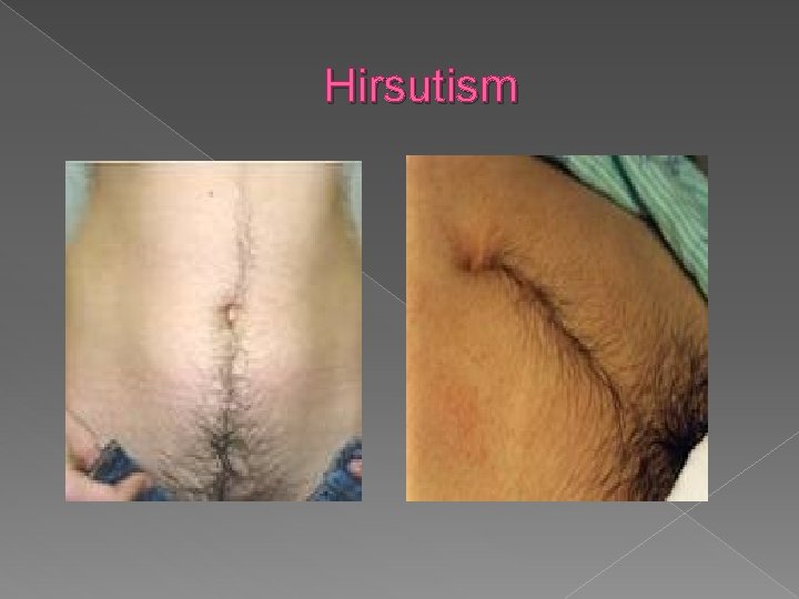 Hirsutism 