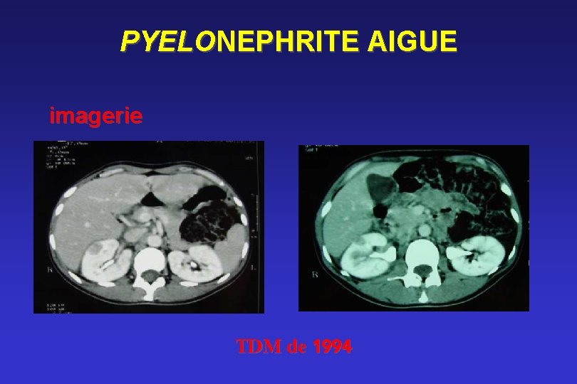 PYELONEPHRITE AIGUE imagerie TDM de 1994 