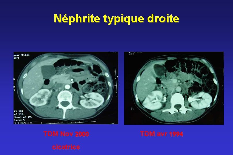 Néphrite typique droite TDM Nov 2000 cicatrice TDM avr 1994 