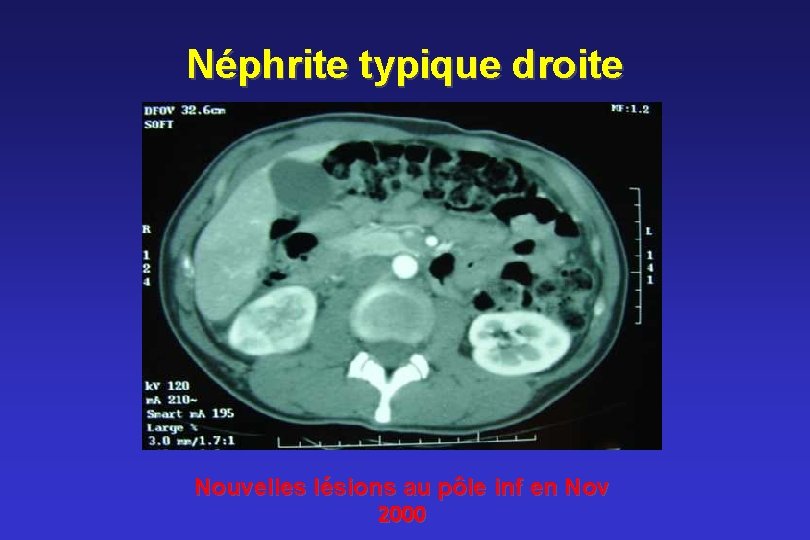 Néphrite typique droite Nouvelles lésions au pôle inf en Nov 2000 