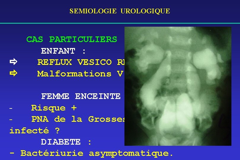 SEMIOLOGIE UROLOGIQUE CAS PARTICULIERS : ENFANT : ð REFLUX VESICO RENAL ð Malformations V.
