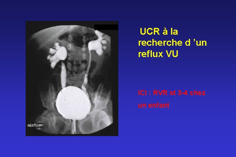 UCR à la recherche d ’un reflux VU ICI : RVR st 3 -4