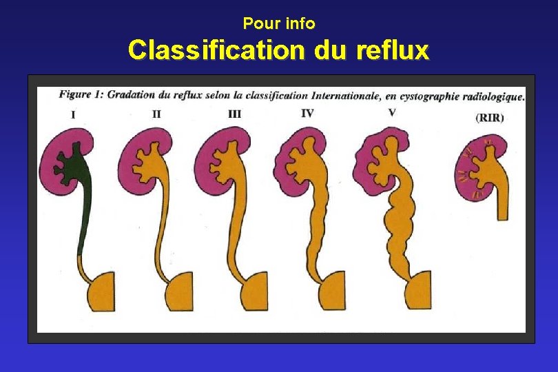 Pour info Classification du reflux 