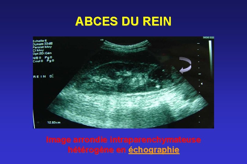 ABCES DU REIN Image arrondie intraparenchymateuse hétérogène en échographie 