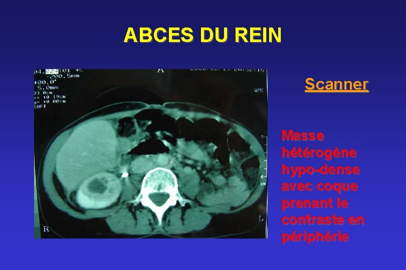 ABCES DU REIN Scanner Masse hétérogène hypo-dense avec coque prenant le contraste en périphérie