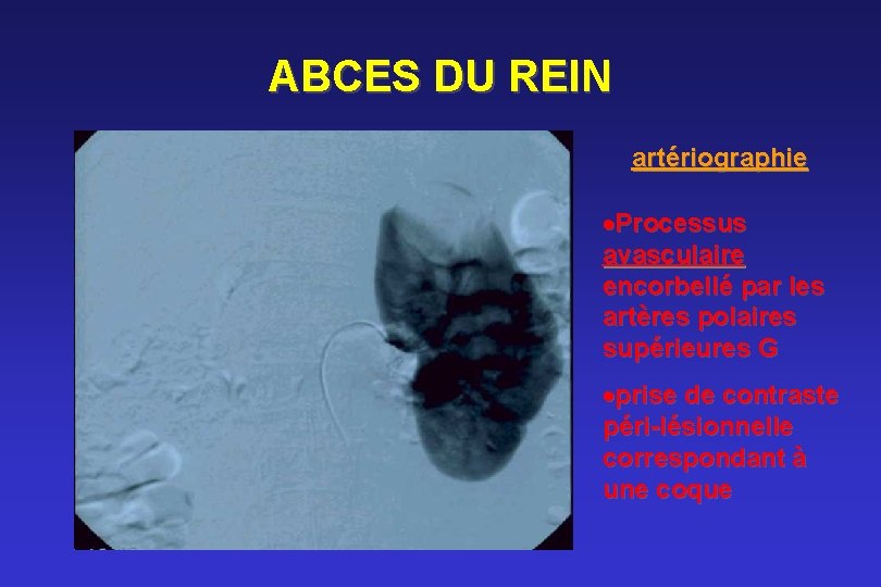 ABCES DU REIN artériographie ·Processus avasculaire encorbellé par les artères polaires supérieures G ·prise