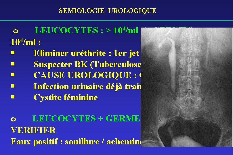 SEMIOLOGIE UROLOGIQUE o LEUCOCYTES : > 104/ml / GERMES : < 104/ml : §