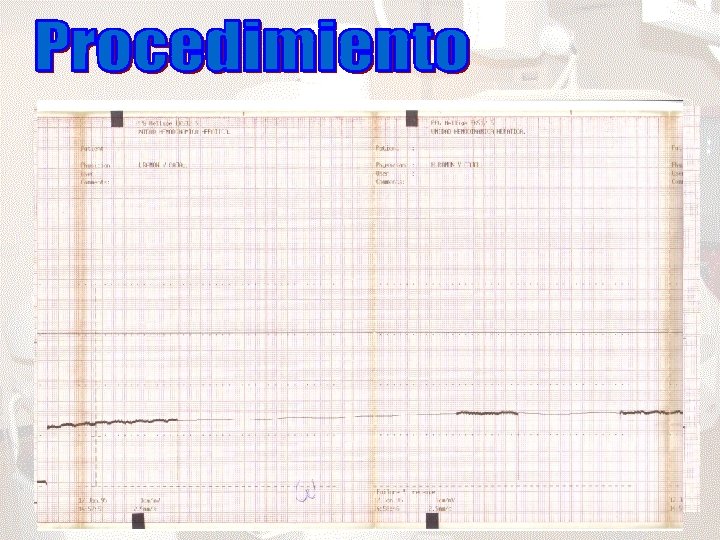 Vía yugular interna Control fluoroscópico Registro de la presión vena cava inferior a nivel