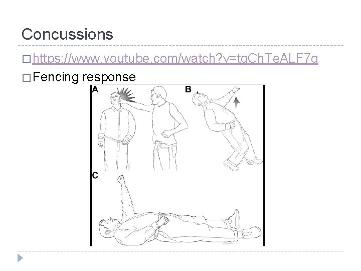 Concussions � https: //www. youtube. com/watch? v=tg. Ch. Te. ALF 7 g � Fencing Concussions � https: //www. youtube. com/watch? v=tg. Ch. Te. ALF 7 g � Fencing