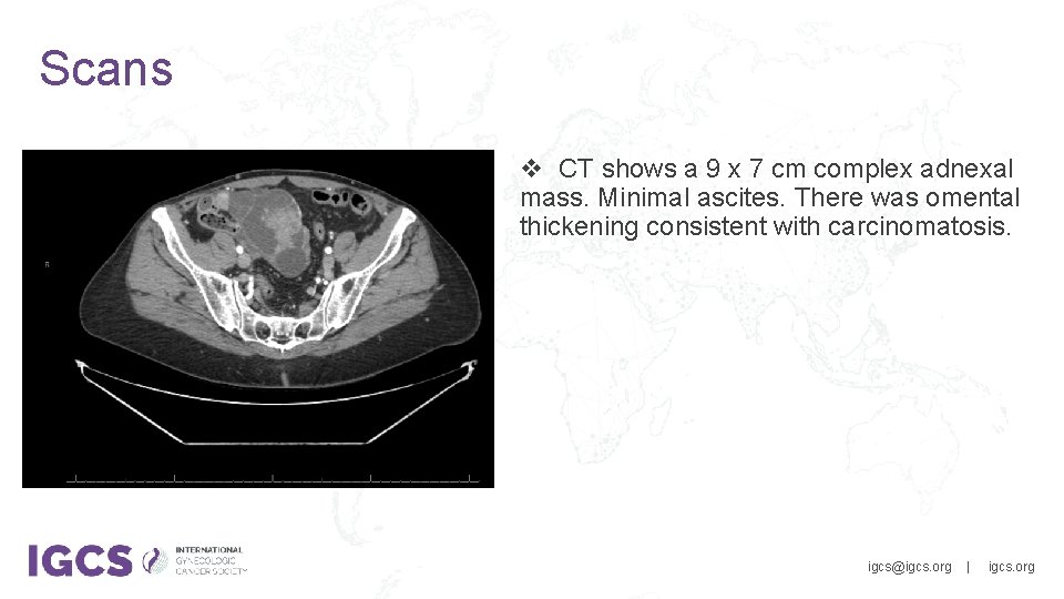 Scans v CT shows a 9 x 7 cm complex adnexal mass. Minimal ascites.