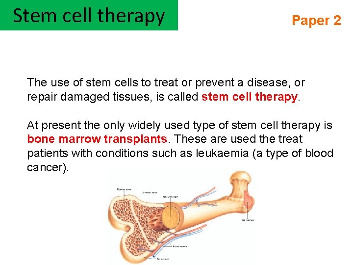 Stem cell therapy Paper 2 The use of stem cells to treat or prevent