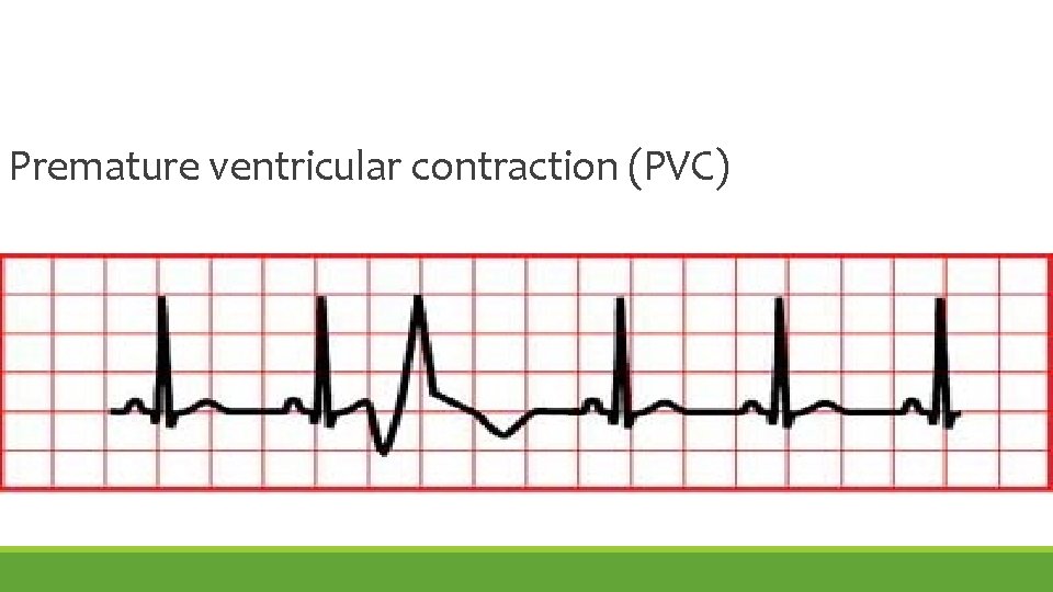 Premature ventricular contraction (PVC) 