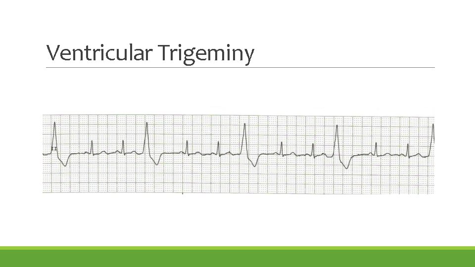 Ventricular Trigeminy 