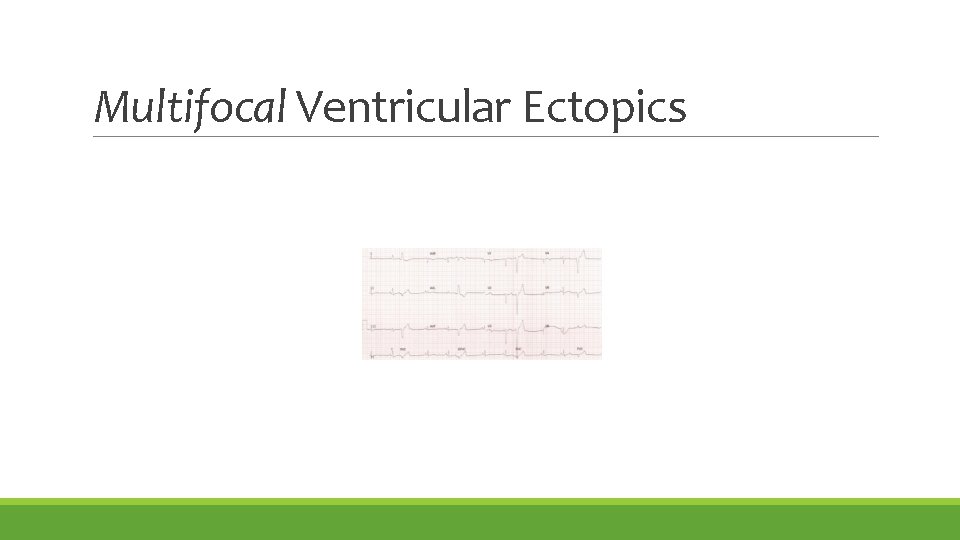 Multifocal Ventricular Ectopics 